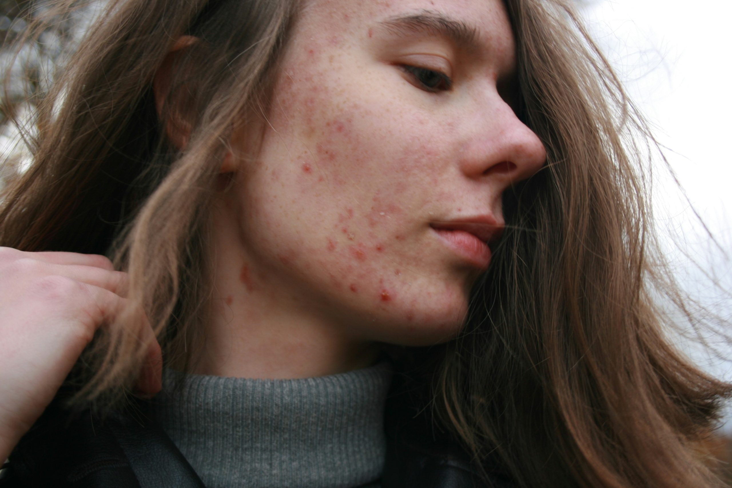 Stres sa môže ukázať aj na koži: Ako spolu súvisia psychika a pokožka?